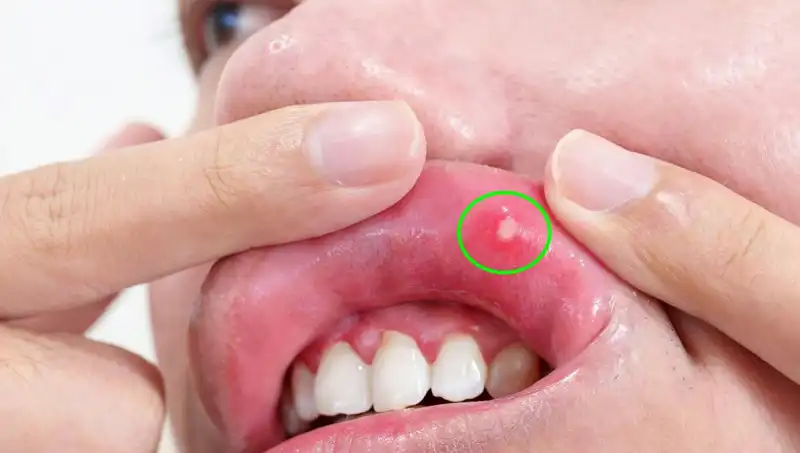 Dil Kanseri Belirtilerine Dikkat Etmeyenlerin Korkunç Sonu: Dilin Alınması Gerekti