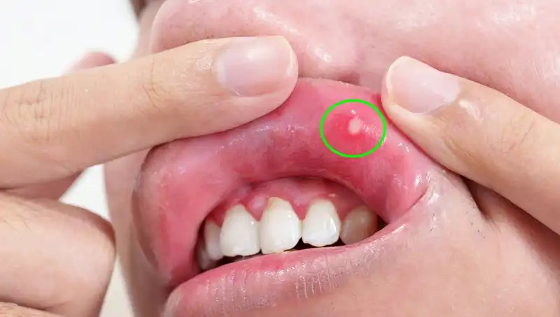 B Vitamini Eksikliği: 5 Belirgin Belirti ve Sağlığınız İçin Önemi